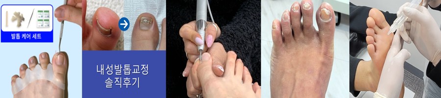 내성발톱 교정 등 케어 사례 (교육 자료)